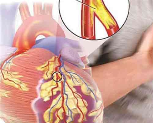 Bệnh tim mạch đang gây gánh nặng tử vong lớn nhất ở Việt Nam