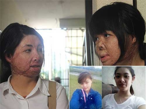 2 cô gái bị chồng đốt tựa vào nhau tìm lại hình hài