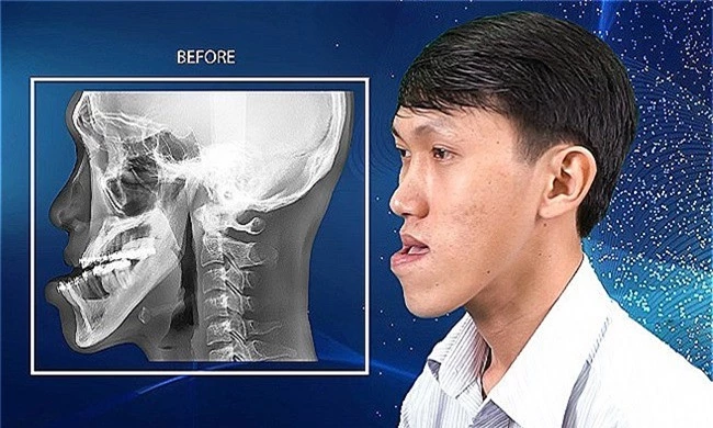 Ca mổ cắt dời hàm mặt giúp chàng trai Ninh Thuận lột xác ngoại hình/ Chàng trai Ninh Thuận lột xác diện mạo sau ca phẫu thuật hàm mặt