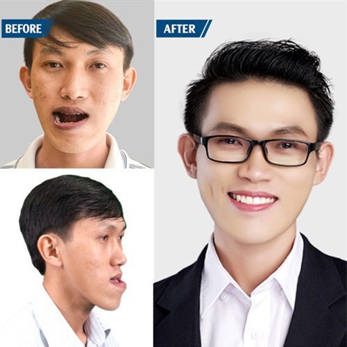 Chàng trai Ninh Thuận 'lột xác' diện mạo sau phẫu thuật hàm mặt