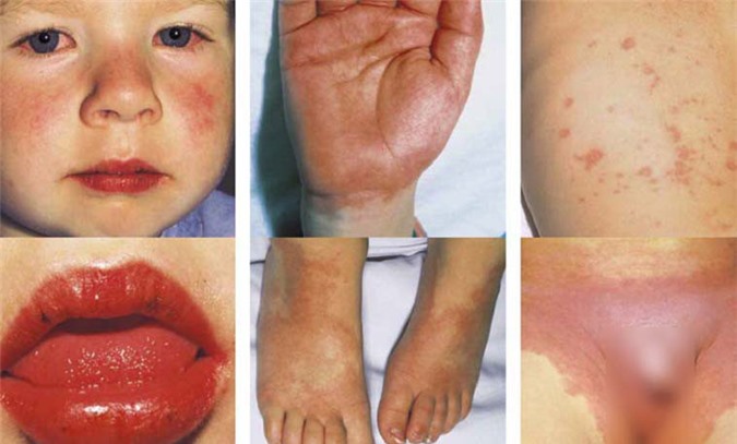 Những điều cần biết về bệnh Kawasaki ở trẻ em