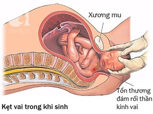 Những điều các mẹ cần biết về tình huống đẻ khó do bé bị kẹt vai trong lúc sinh thường
