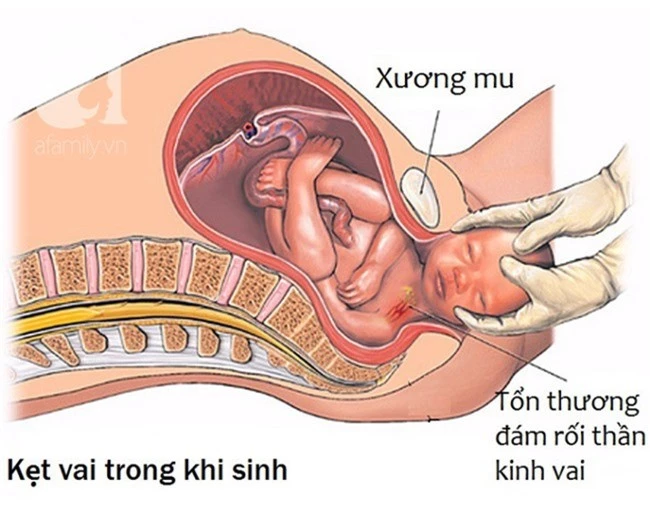 Những điều các mẹ cần biết về tình huống đẻ khó do bé bị kẹt vai trong lúc sinh thường - Ảnh 3.