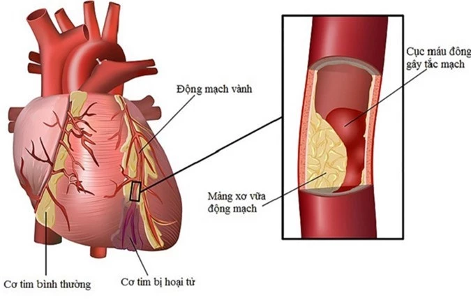 Bệnh nhi mắc Kawasaki phải đối mặt với các biến chứng về tim mạch.