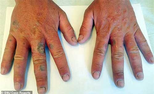 Uống xong loại nước tưởng "lành nhất quả đất", làn da chàng trai thối rữa như zombie