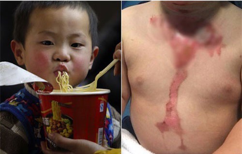 Có một mối nguy hiểm từ cháo và mỳ ăn liền đe dọa sức khỏe của trẻ mà cha mẹ không ngờ tới