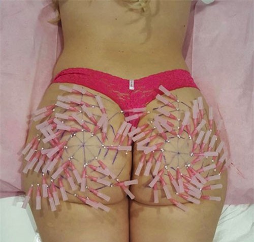 Gắn chi chít 100 mũi kim tiêm vào vòng 3 để gìn giữ xuân thì