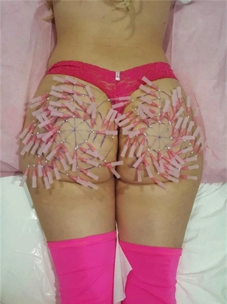 Cận cảnh mạng lưới kim tiêm trên mông của Marcela Iglesias