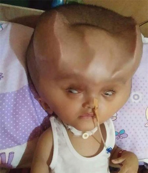 Em bé 1 tuổi mang cặp sừng 'quỷ dữ' sau ca phẫu thuật bất thành