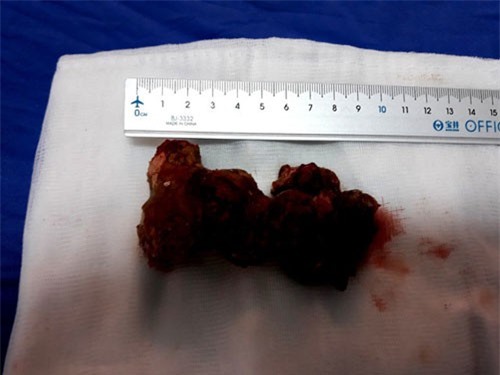 Lấy khối sỏi thận khủng trong thận bệnh nhân 60 tuổi