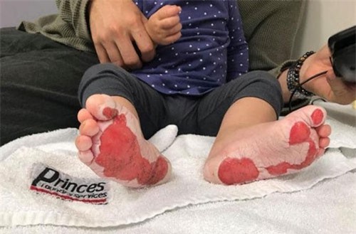 Thứ rất phổ biến ở công viên có thể khiến trẻ bị bỏng đến mức này nhưng chẳng mấy ai để ý