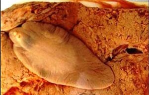 'Phát hoảng' với cô gái Sơn La nặn ra sán ngoe nguẩy ở vùng ngực