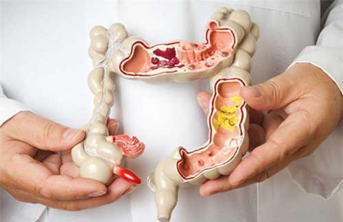 Điều trị ung thư ruột hiệu quả bằng thuốc giá rẻ