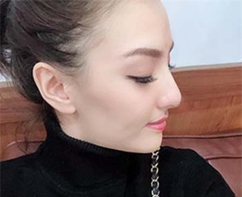 Hồng Quế phẫu thuật nâng mũi để 'thay đổi vận mệnh'