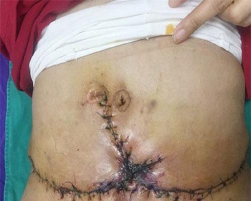 Hoại tử nặng vì hút mỡ bụng giảm béo