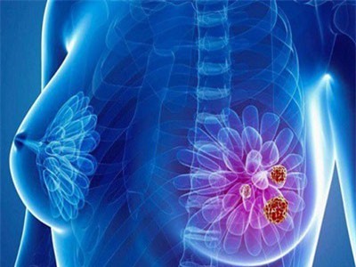 Ung thư vú, căn bệnh có thể xuất hiện ở bất cứ ai