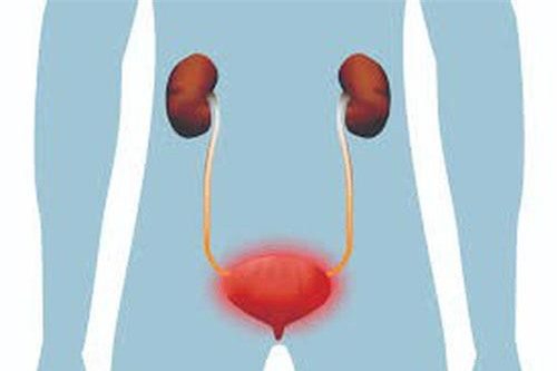 Cần tránh những điều này khi mắc viêm đường tiết niệu