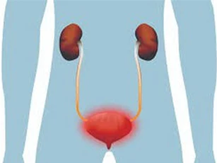Cần tránh những điều này khi mắc viêm đường tiết niệu