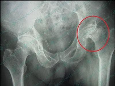 Thủ phạm gây hoại tử chỏm xương đùi ở nam do lạm dụng rượu bia và hút thuốc lá 