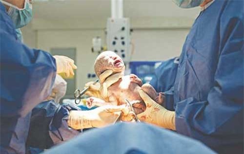 Có thật sinh mổ gây chứng "não cá vàng"?