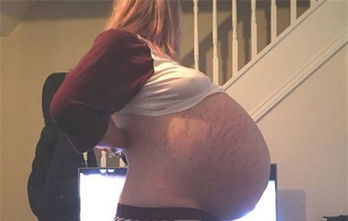 Ròng rã nhiều tháng trời mang khối u khổng lồ lại cứ tưởng có bầu