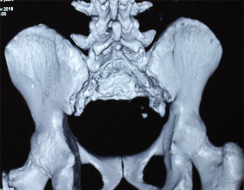 Hiếm gặp: Bệnh nhân bị bướu ăn hết vùng xương thiêng, mất dần khả năng đi lại