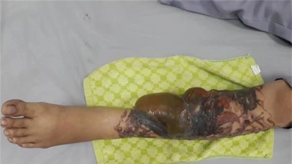Cô gái trẻ bị hoại tử chân, lộ cả gân vì xoá hình xăm bằng laser