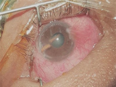 Chấn thương nặng vì dụi mắt sau khi bị gai mây đâm xuyên nhãn cầu