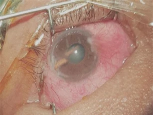 Chấn thương nặng vì dụi mắt sau khi bị gai mây đâm xuyên nhãn cầu
