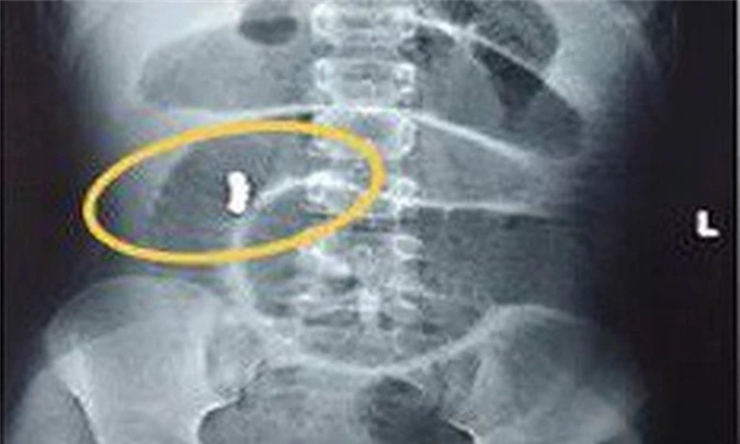 Hình chụp X-quang cho thấy dị vật trong bụng bệnh nhi.