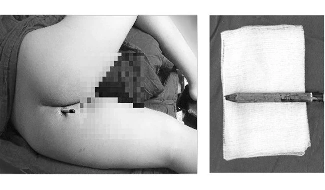 Cháu bé 9 tuổi ở huyện Củ Chi (TPHCM) bị cây bút chì đâm sâu vào mông và phẫu thuật sau khi lấy ra (ảnh BM)