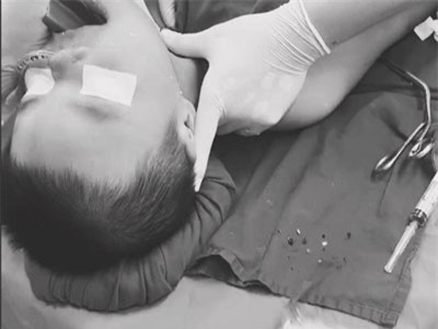 Trẻ 5 tuổi ở Long An nguy kịch do hóc hạt hồng xiêm