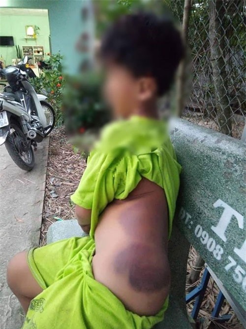 Long An: Bé trai khuyết tật 7 tuổi bị cô giáo đánh bầm tím cả cơ thể