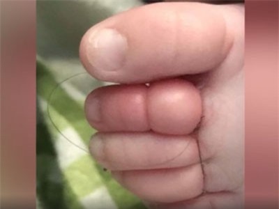 Clip: Bé sơ sinh suýt phải cắt bỏ ngón chân, khi biết nguyên nhân thì ai cũng phải bất ngờ