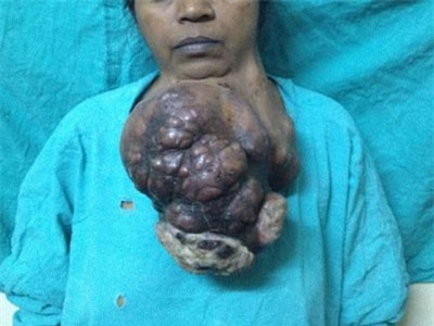 Người phụ nữ mang khối u nặng hơn cả em bé sơ sinh dưới cằm