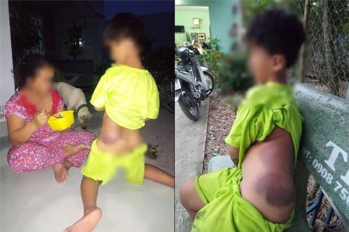 Vụ cô giáo đánh học sinh khuyết tật bầm tím: Mẹ bé trai tiết lộ sự thật gây ‘sốc’