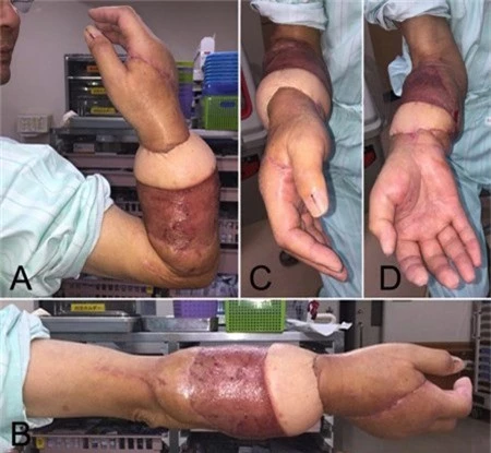 Cận cảnh cánh tay sau ca phẫu thuật ghép nối của các bác sĩ