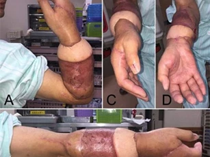 Mục sở thị một ca phẫu thuật nối liền cánh tay bị đứt lìa