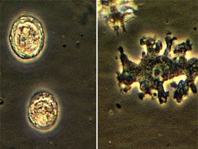 Bệnh nhân kì lạ tại Mỹ bị amip ăn não khi vẫn… đang sống