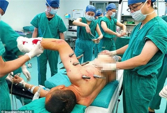 Mười cọc thép đâm thủng ngực và tay bệnh nhân