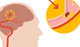 Clip: Các dấu hiệu cảnh báo đột quỵ sớm