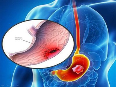 Tìm hiểu về khối u dạ dày lành tính, ác tính