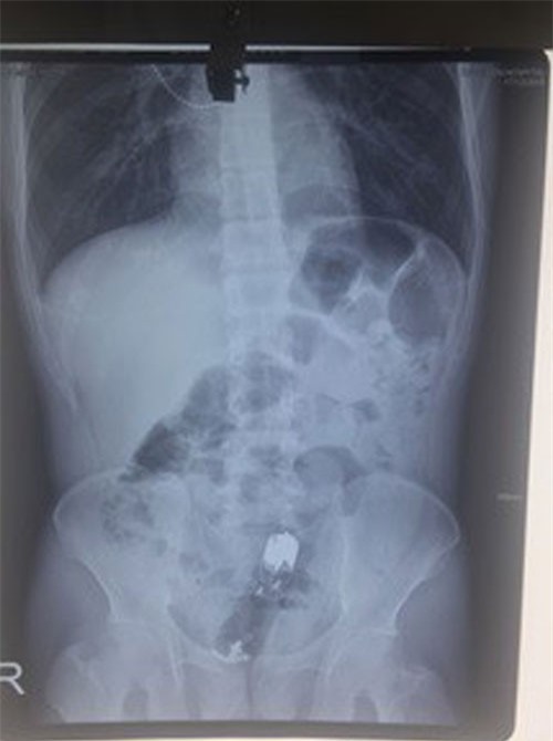 Ngỡ ngàng: dương vật giả mắc kẹt trong trực tràng bệnh nhân