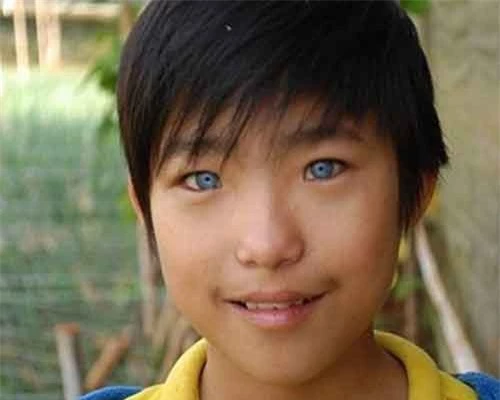 Cậu bé Nguyễn Văn Hào ở Đà Lạt sinh năm 1999 cũng sở hữu đôi mắt màu xanh nước biển khiến nhiều người ngỡ ngàng. Đôi mắt lạ khiến bé Hào gặp không ít phiền toái.
