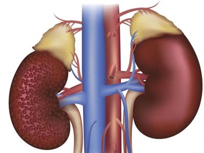 Bệnh thận - biến chứng đáng sợ của đái tháo đường