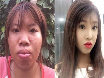 Phượng 'Thị Nở' tái xuất xinh đẹp sau 2 tháng nghi biến chứng thẩm mỹ