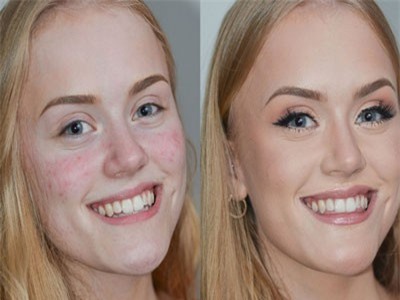 Qua tuổi dậy thì mà vẫn thấy mụn mọc ầm ầm thì xem lại ngay các nguyên nhân sau