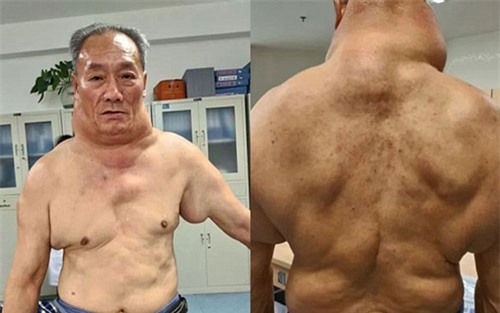 26 năm uống rượu, người đàn ông thành ‘quái vật’ với chiếc cổ kì dị