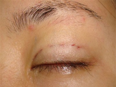 Nhiều ca tai biến sau khi thẩm mỹ nhấn mí mắt