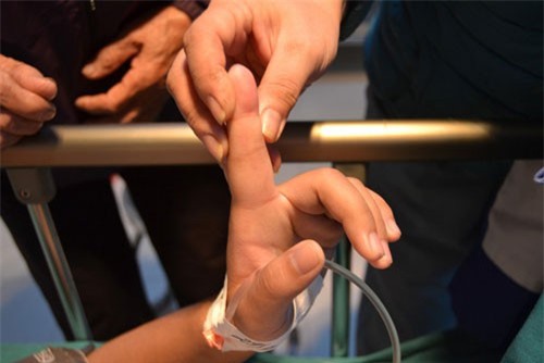 Hy hữu ca sốc phản vệ do kiến cắn ngón tay